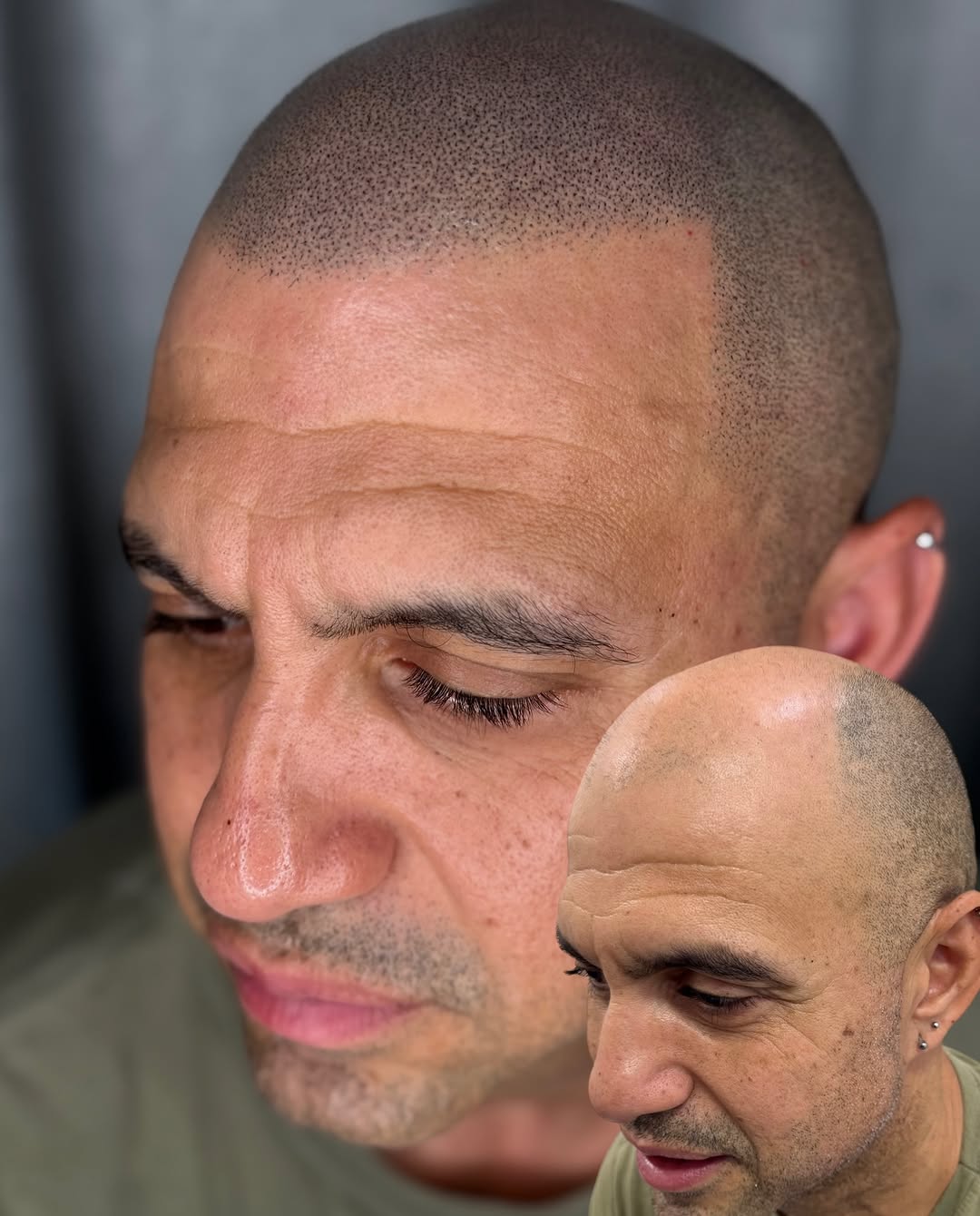 Resultado de micropigmentação capilar realista — Studio Siomara, Florianópolis